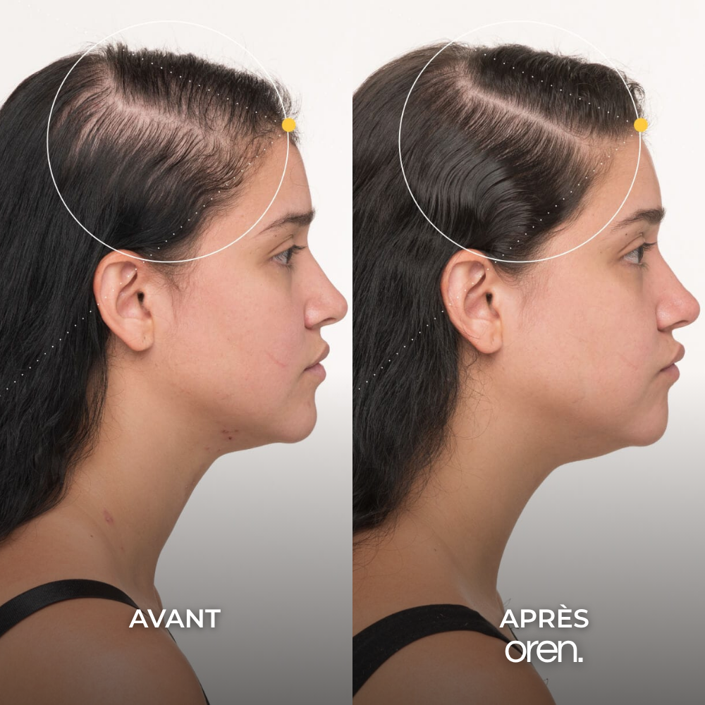 Pépins de Courge Softgels — Anti-DHT Naturel